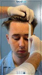 Updated Hair Transplant Cost in Turkey 2023