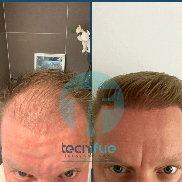 FUE Hair Transplant Result of TecniFUE International