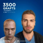 Before and After Hair Transplant Jordan 3500 Grafts