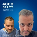 Before and After Hair Transplant Khalid 4000 Grafts FUE