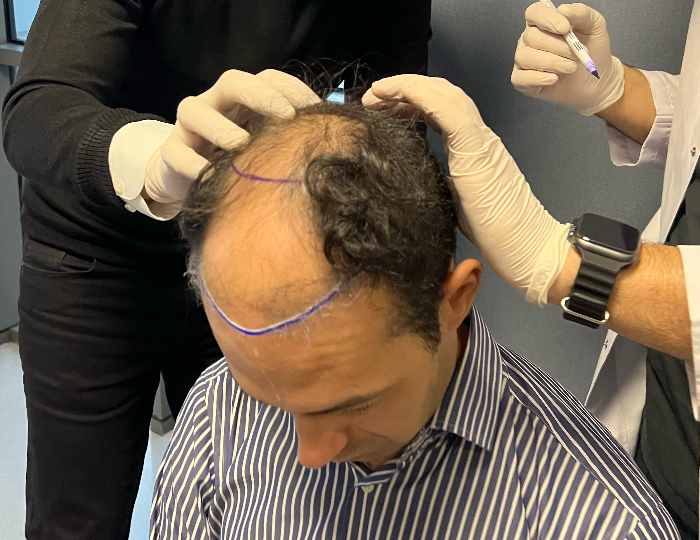 Hair Transplant Consultation Before the FUE Hair Transplant