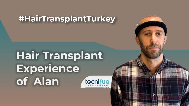 Hair Transplant Experience of Alan with TecniFUE International