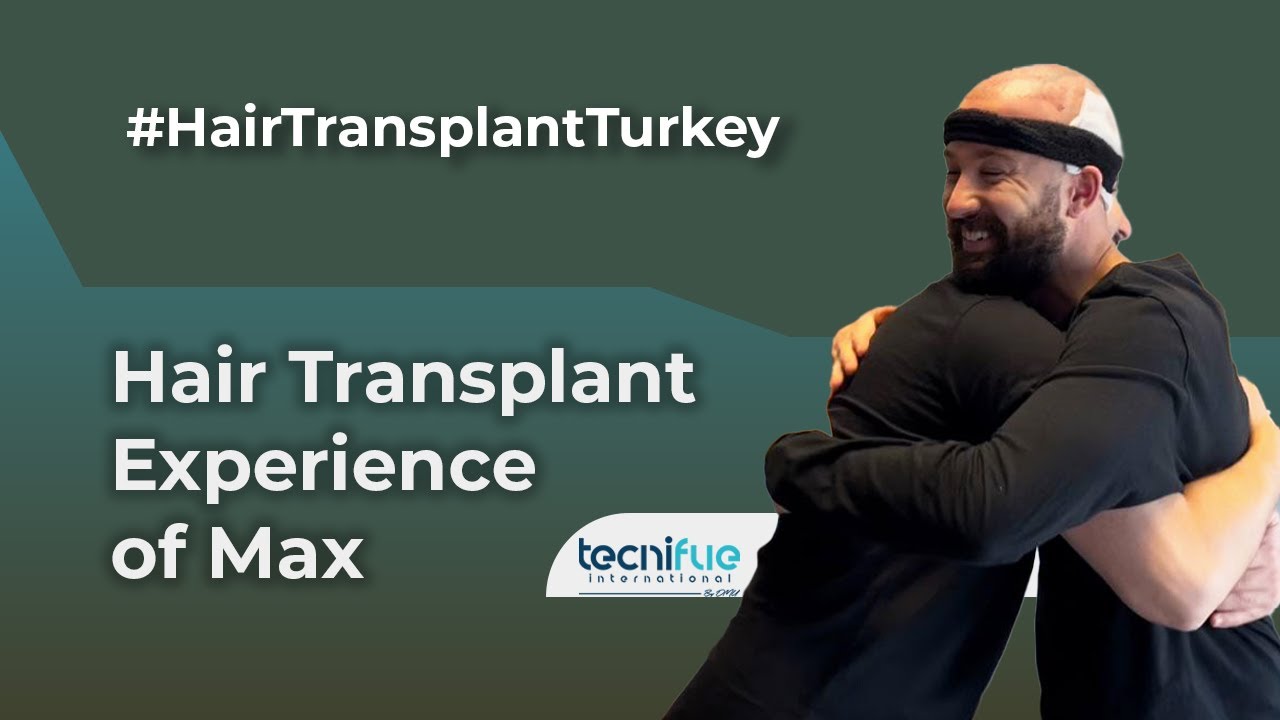 Hair Transplant Experience of Max with TecniFUE International