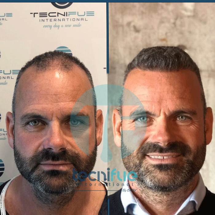 Hair Transplant Before and After Result of TecniFUE Hair Clinc